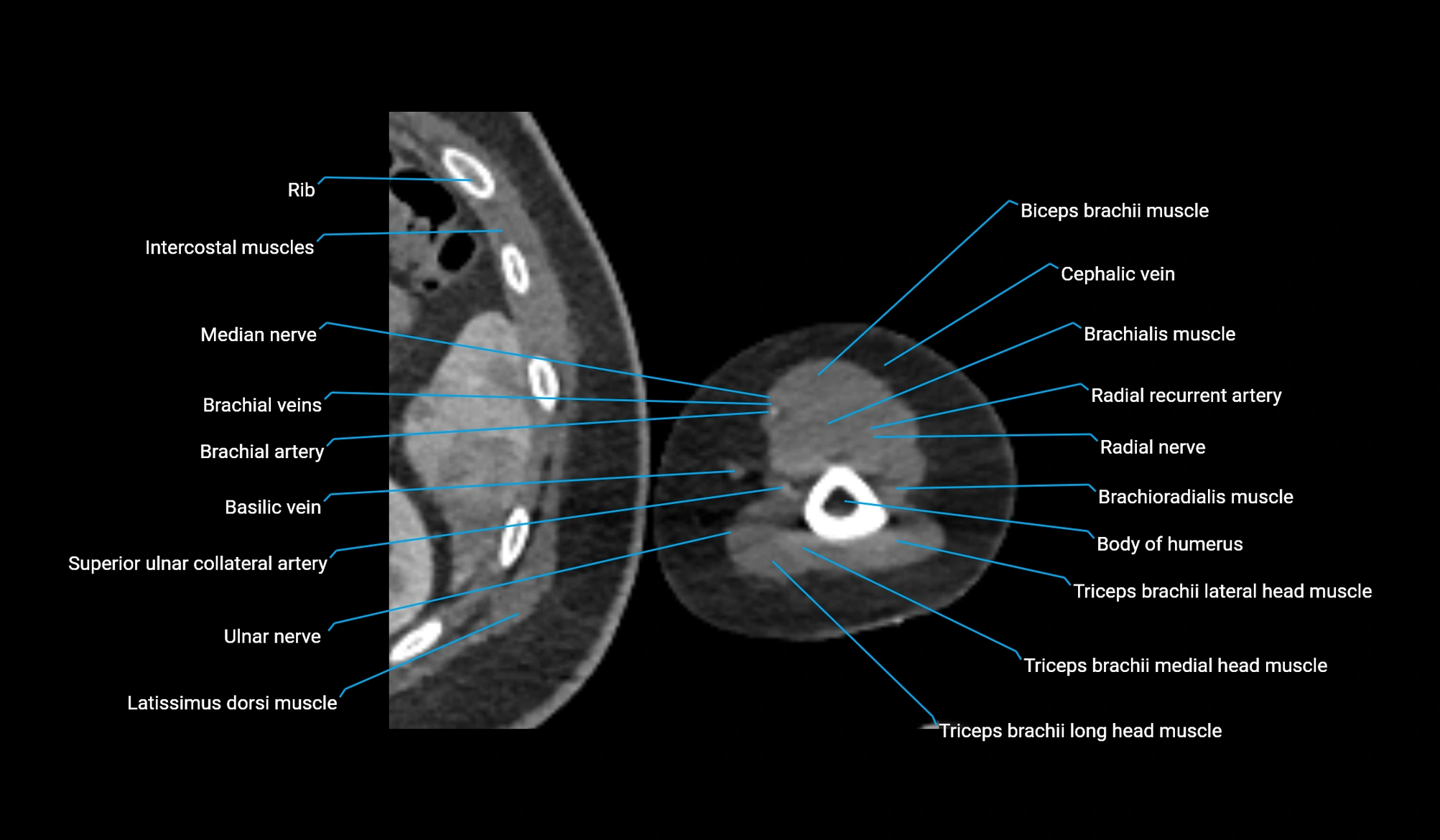 CT upper arm axial  cross sectional anatomy labelled radiology image -00328.webp